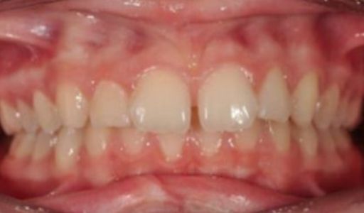 Efekty leczenia Ortodoncja